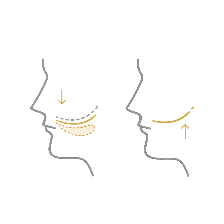 Augenringe Unterpritzung: Ursache & Eignung
