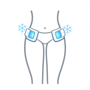 Medizinische Kryolipolyse an den Oberschenkeln